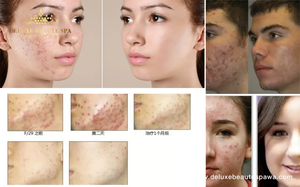 Acne-Facial-1