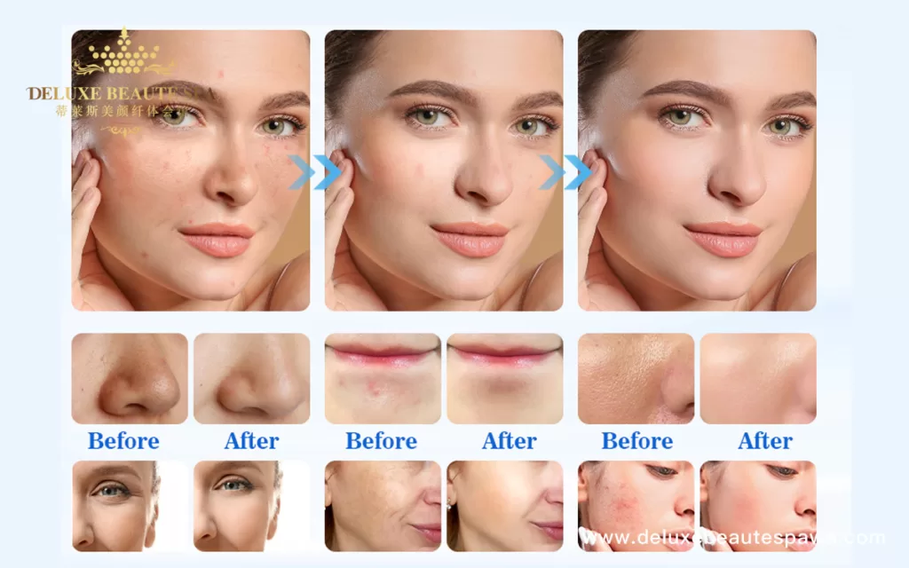 Diamond-Microdermabrasion-2