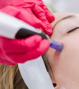 Micro Needling - Deluxe Beaute Spa