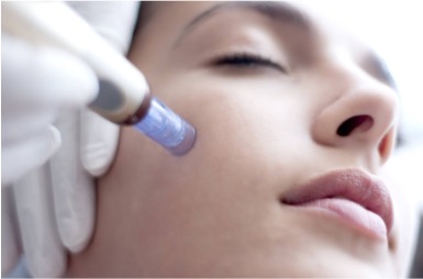 Microneedling Facial
